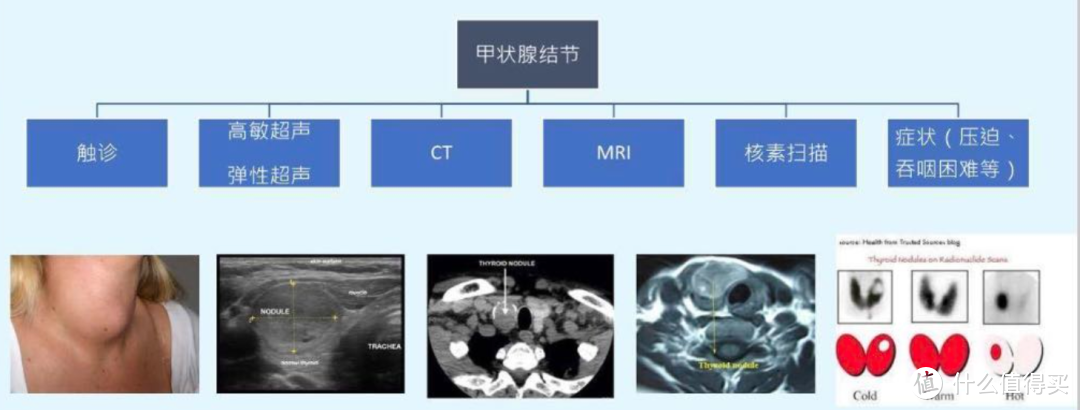 你不得不知的体检异常——甲状腺结节！