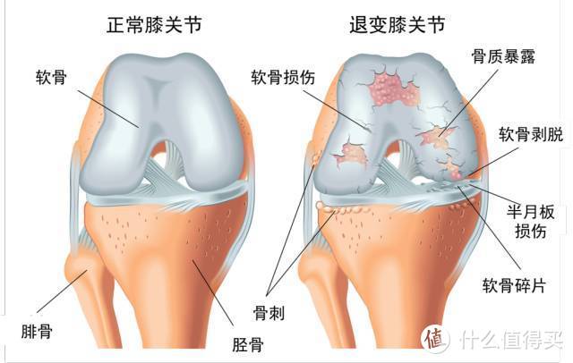 跑步百利唯伤膝？不跑步别乱说，不运动可能更伤膝！