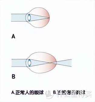 近视眼会不会影响买保险？