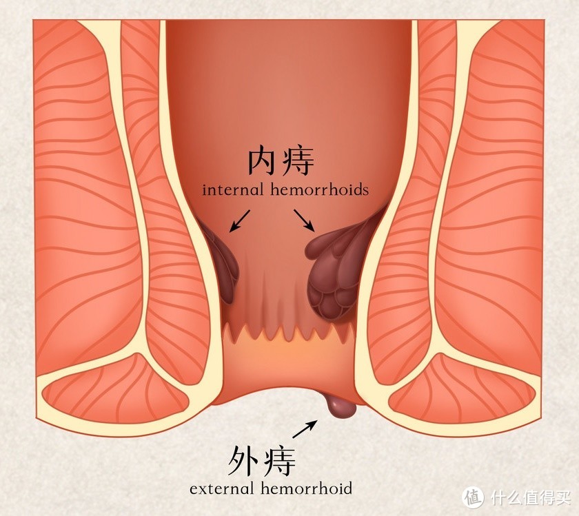 我的痔疮手术流水账（含肛瘘、肛周脓肿）