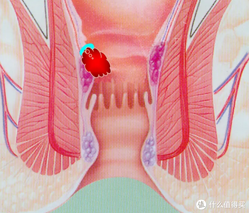 大概是这样，黑线勒住内痔，让它坏死脱落。