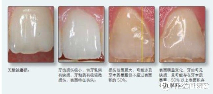 （从左到右，牙釉质流失损伤越发严重）