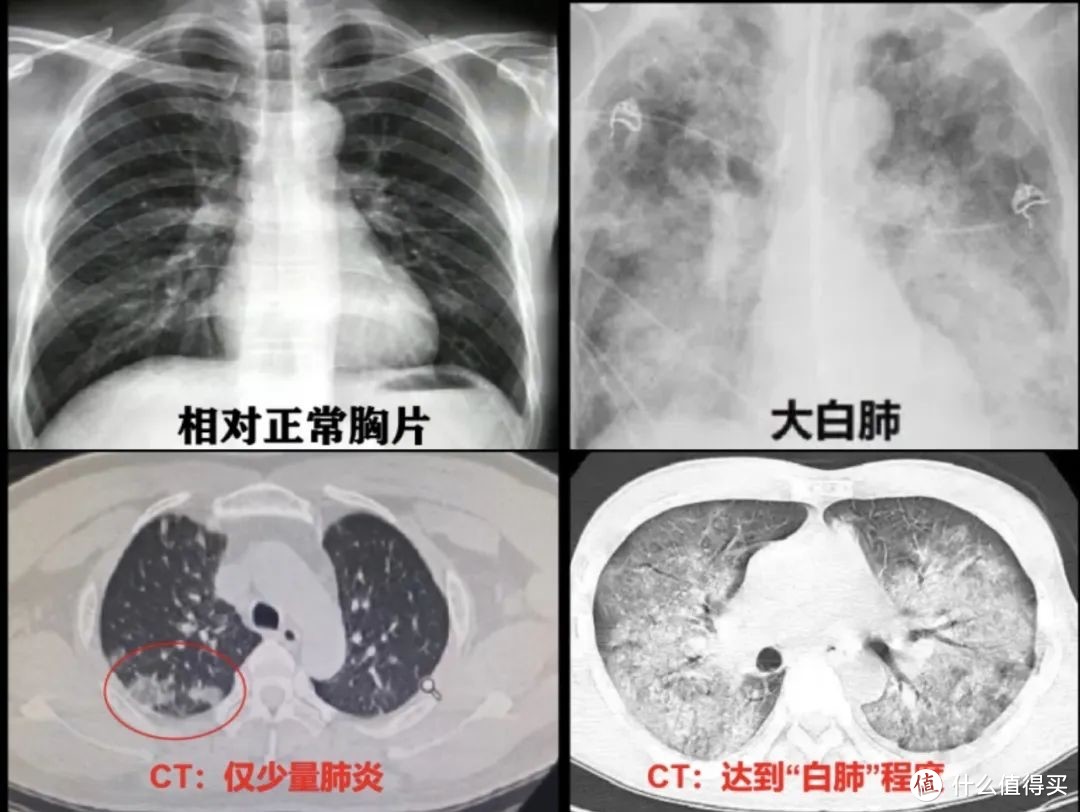 转阴后还在咳，会变成肺炎吗？需不需要去做CT，多位医生详解（内含低价CT套餐）