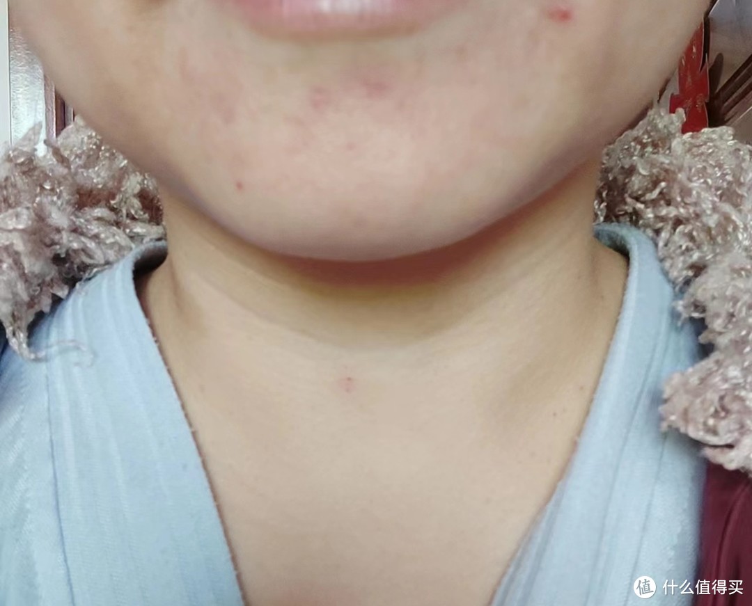 皮肤问题：痘印、法令纹严重，肤色不均匀，脖颈细纹明显。