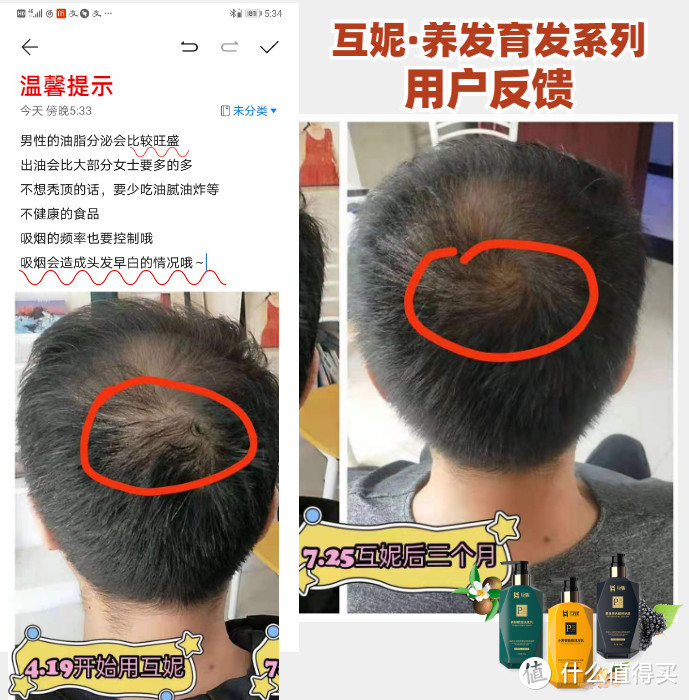 男性的油脂分泌比女性还要多！ 要杜绝秃顶问题更要注意生活习惯 坚持使用互妮养发育发系列，搭配良好的生活习惯 短短三个月就看见成效啦