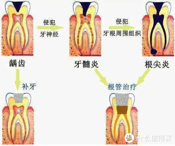 蛀牙发展过程