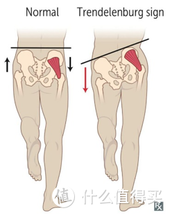 右侧臀肌无力，无法把骨盆往下拉，导致身体向左倾斜