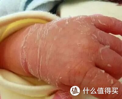 宝宝出生后为什么会脱皮？怎么护理宝宝的皮肤都告诉你了，别错过