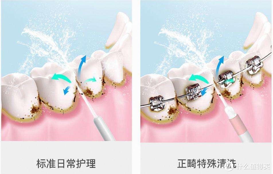 正畸牙齿矫正能用冲牙器吗？三大害处禁忌爆料！
