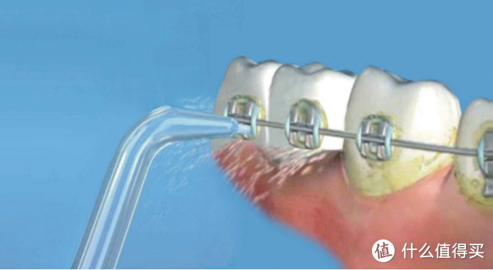 牙齿矫正正畸可以用冲牙器吗？严防四大潜规则黑幕！