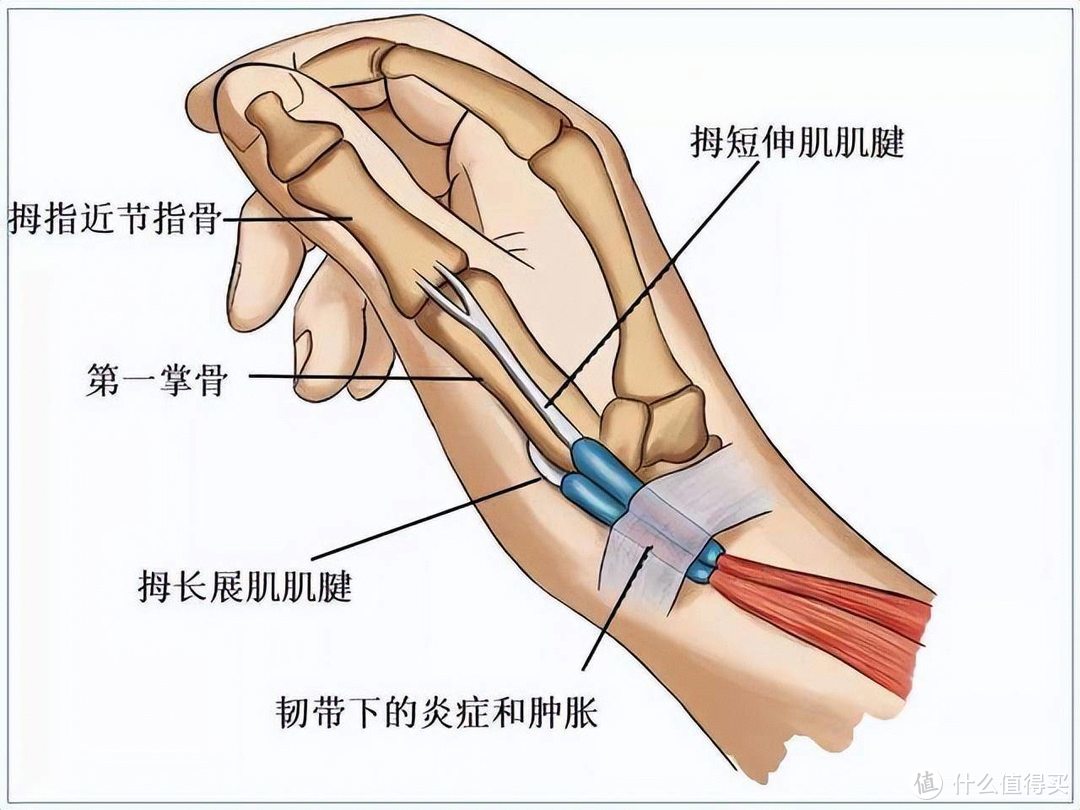 手指出现疼痛，往往是大问题，一文让你彻底了解腱鞘炎！