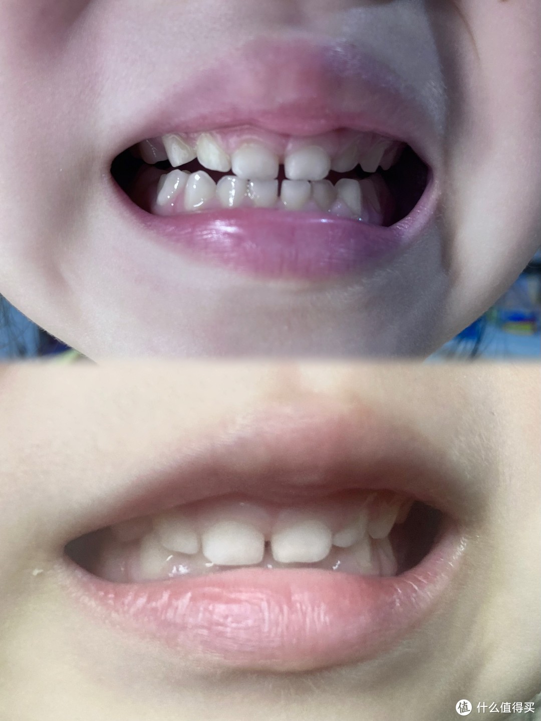 我国5岁儿童70%龋齿，乳牙蛀了真没关系吗？如何帮孩护牙选对牙膏一文说清