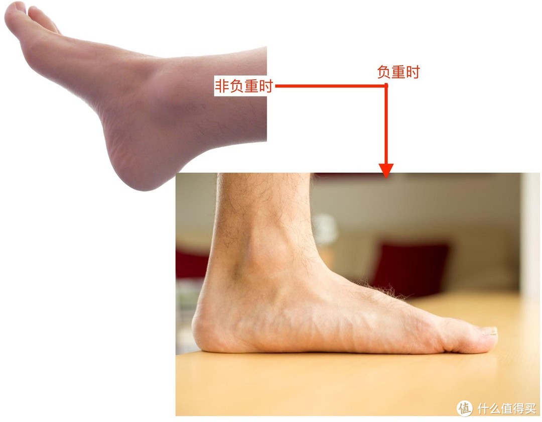 足部在负重情况下呈现扁平足状态