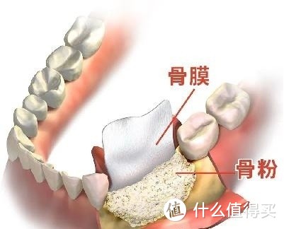 听值友的吧！我算是把种植牙的价格写明白了!