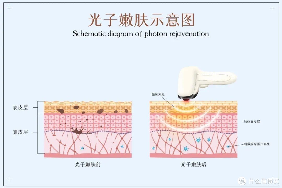 光子嫩肤示意图