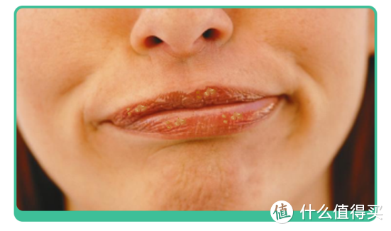 从“嘴起皮”到“慢性唇炎”，90%的人都是被这个小动作害的