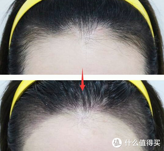 怎么让发际线长回来？11大发质护养内幕危害，需严防！