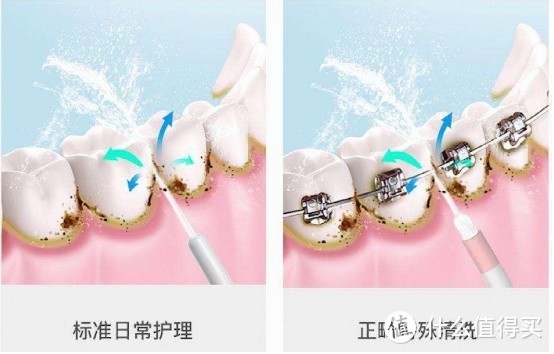 牙医是否推荐使用冲牙器？3大缺陷槽点务必小心！