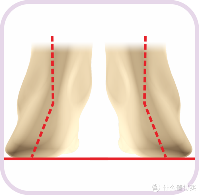 孩子足外翻，需要矫正鞋垫与矫正鞋的双重呵护