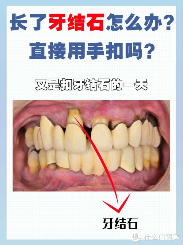 长了牙结石怎么办直接用手抠吗千万不要