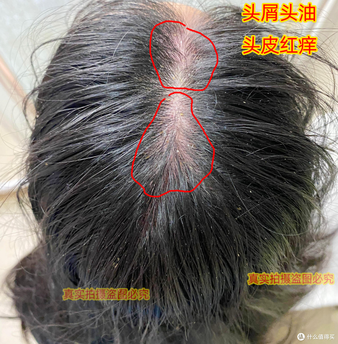 去屑洗发水哪个牌子好？明星都在用的去屑神器，一瓶解决头皮问题！