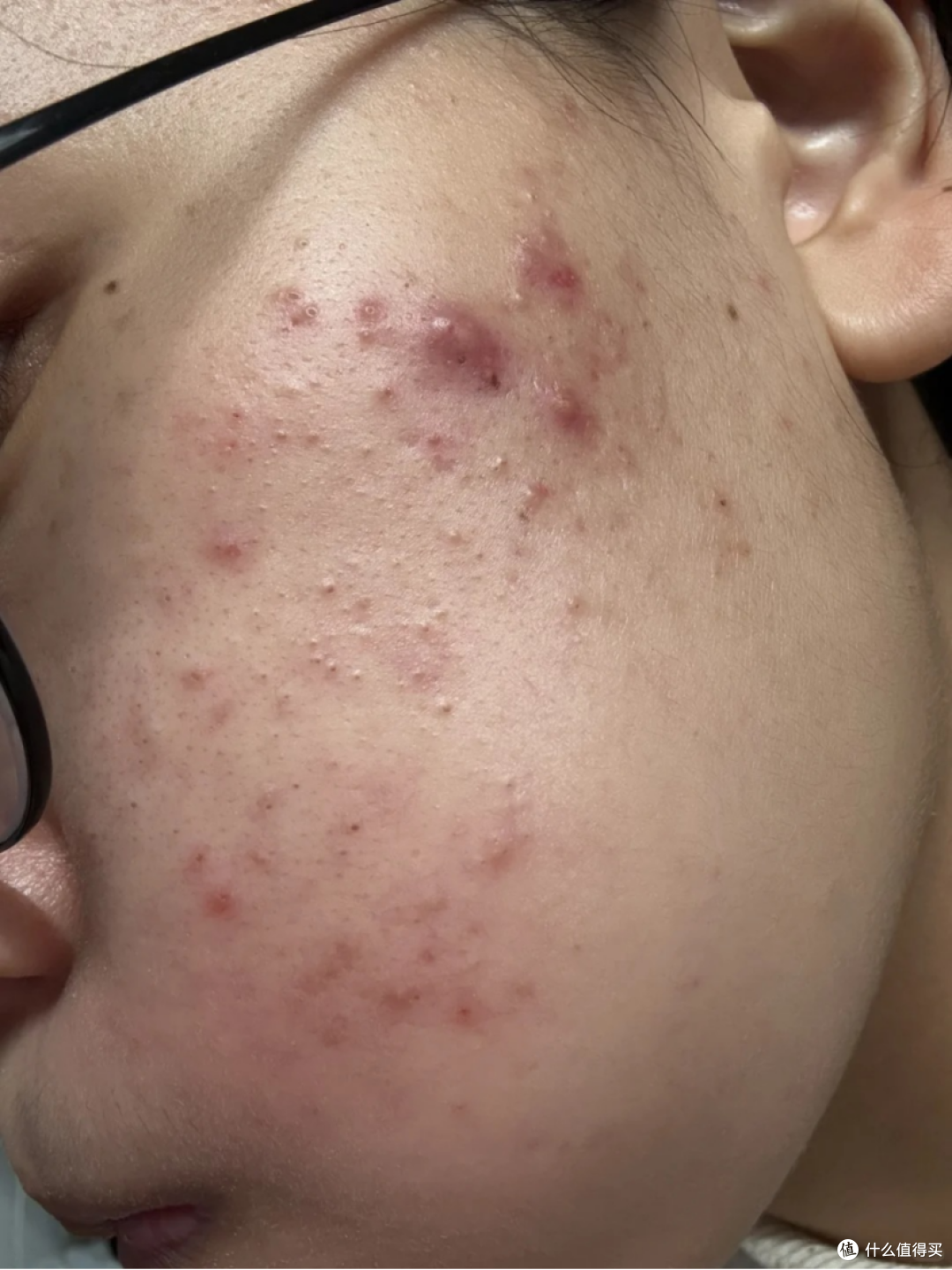 重度痤疮是肝火旺看完这篇就好了只发一次